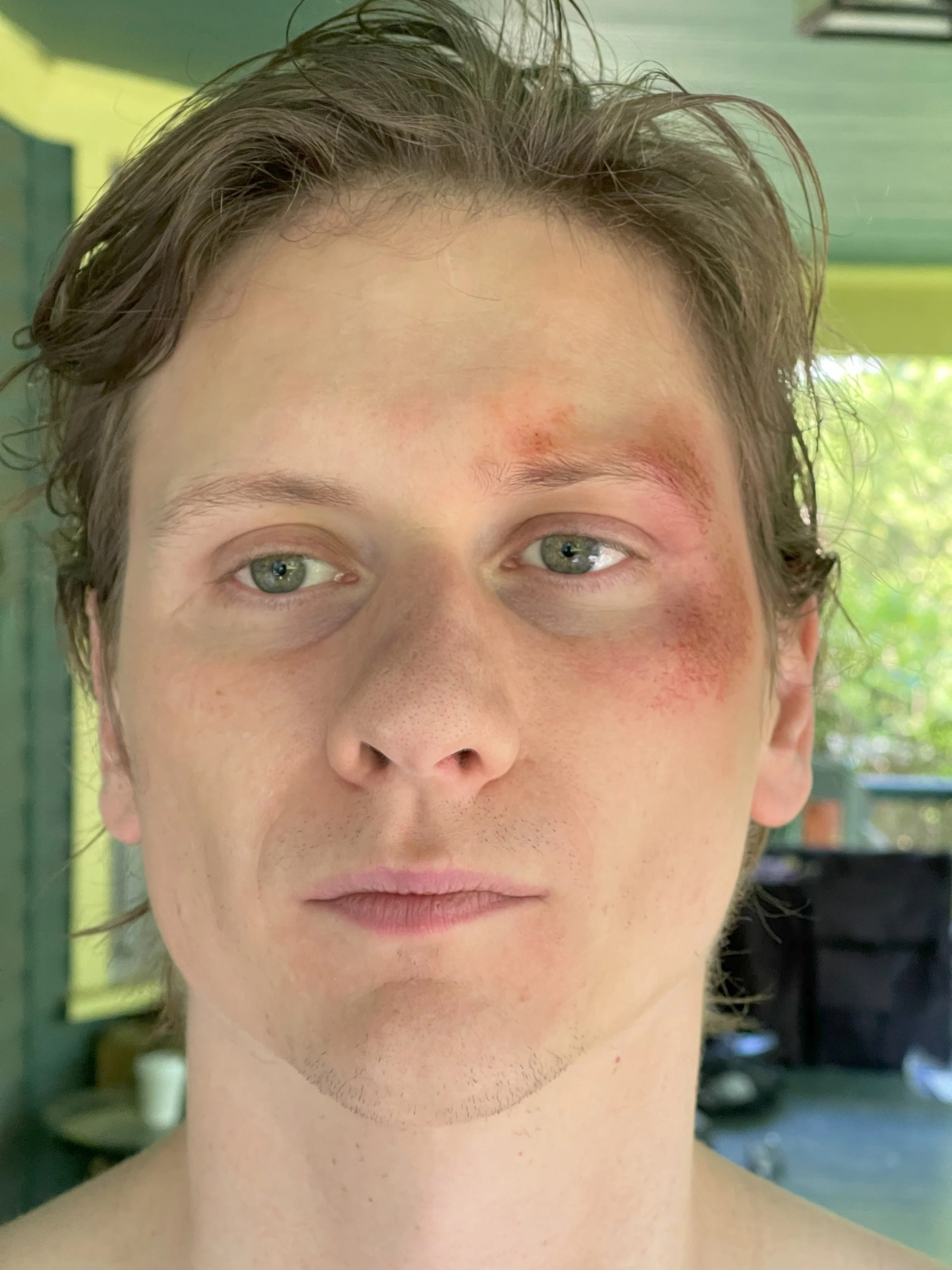Close-up of a man's face showing scraped skin and redness around the right eye.