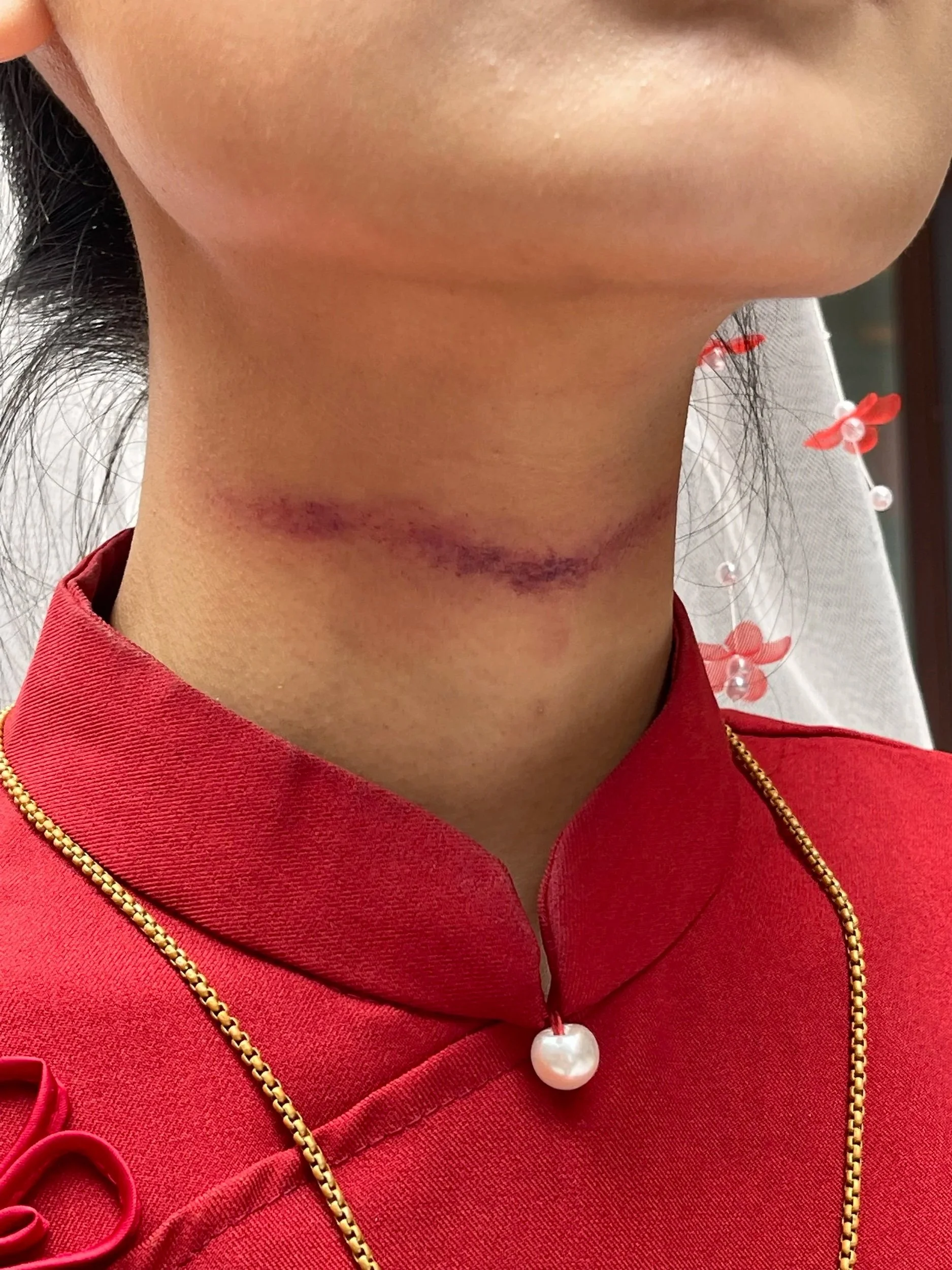 Close-up of a person's neck with a horizontal scar, wearing a red outfit with a gold chain and white beads with red flower accents.