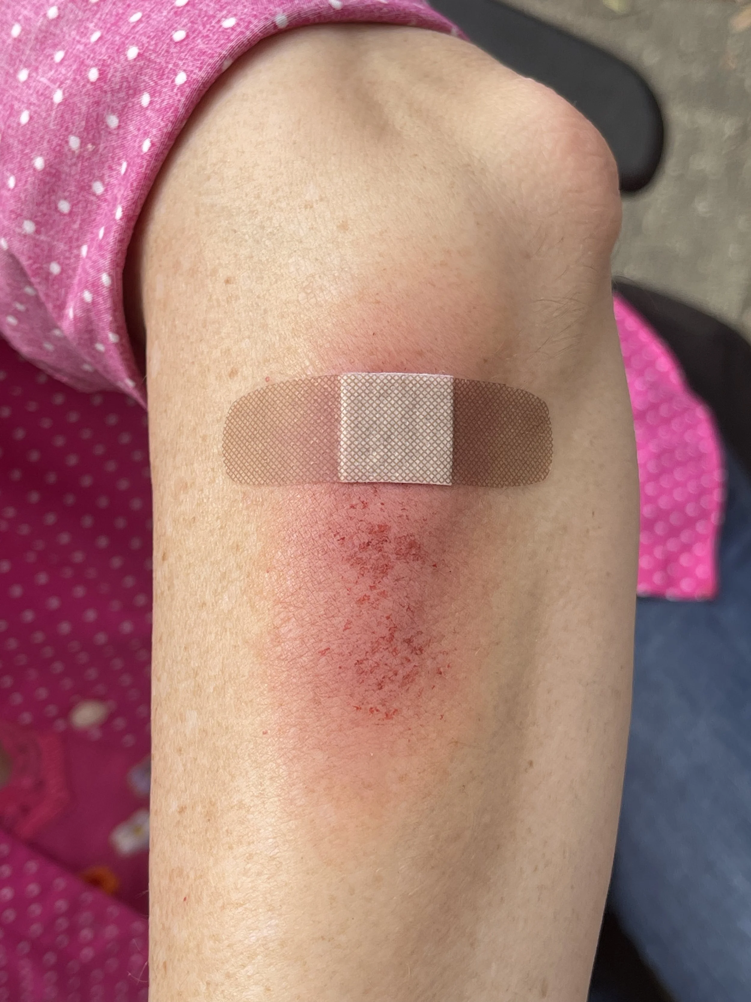 Close-up of a person's upper arm with a pinkish bandage applied, slightly reddened around the bandage, and part of a pink polka-dot shirt visible.
