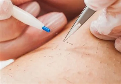 Close-up of a person performing a cosmetic procedure, using a fine needle and a pen to treat the skin.