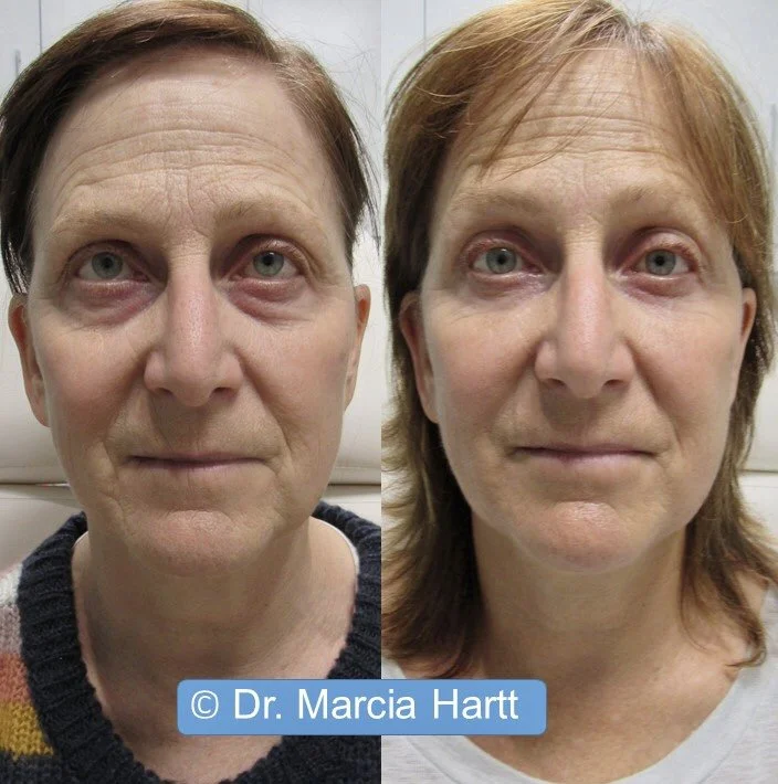 Before and after image of an advanced cosmetic injection dermal filler undereye treatment by Dr. Marcia Hartt at External Affairs Medical Spa in St. Albert