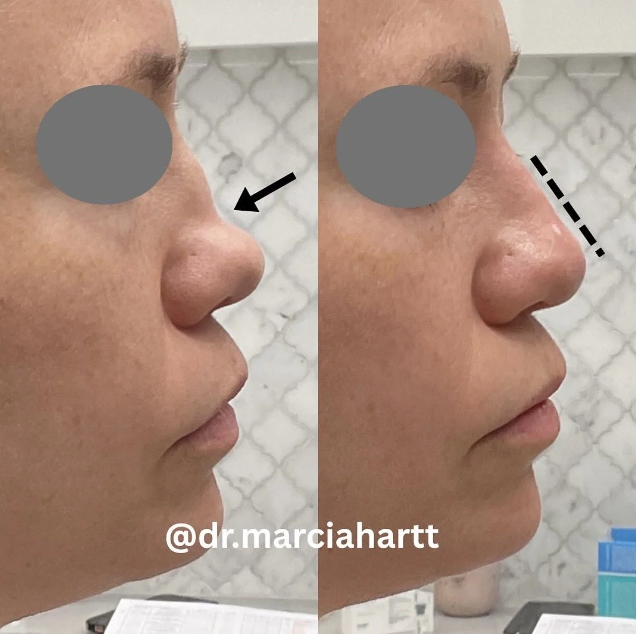 Before and After of advanced non-surgical rhinoplasty transformation on woman's nose in St. Albert by advanced injector Dr. Hartt