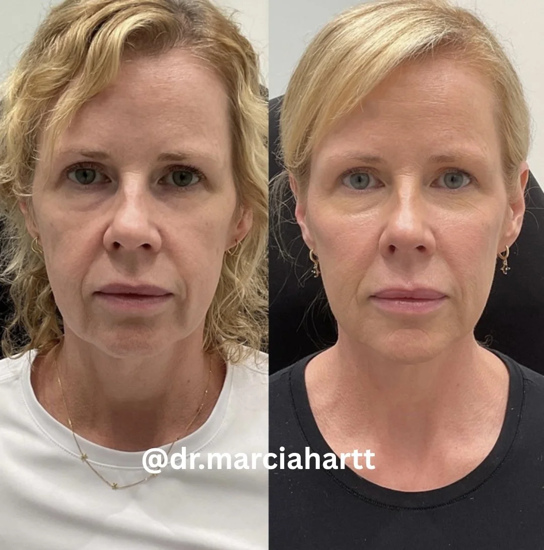 Before and after facial balancing focused on midface volume and lower-face harmony by Dr. Marcia Hartt.