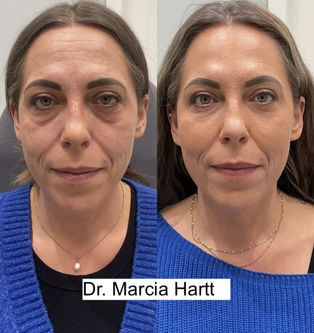 Drastic before and after transformation using dermal fillers to midface and under eyes