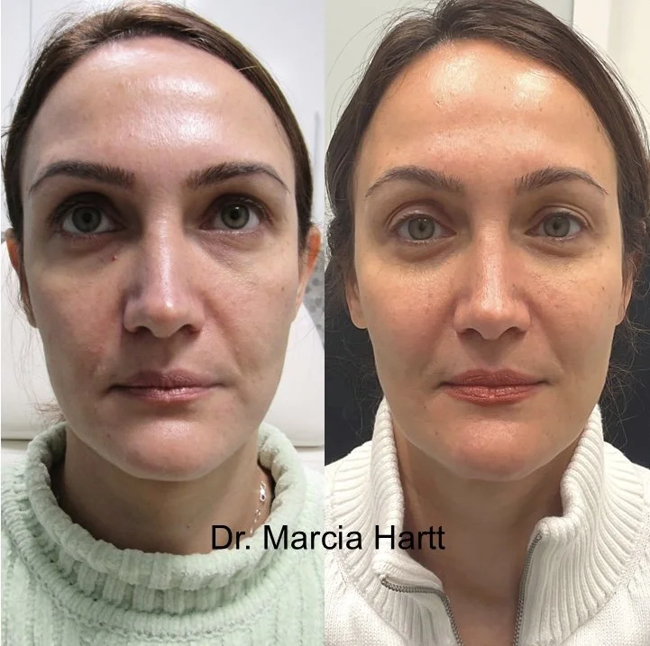 Before and after showing improved midface volume and underlie shadows reduced by Dr Hartt in St. Albert