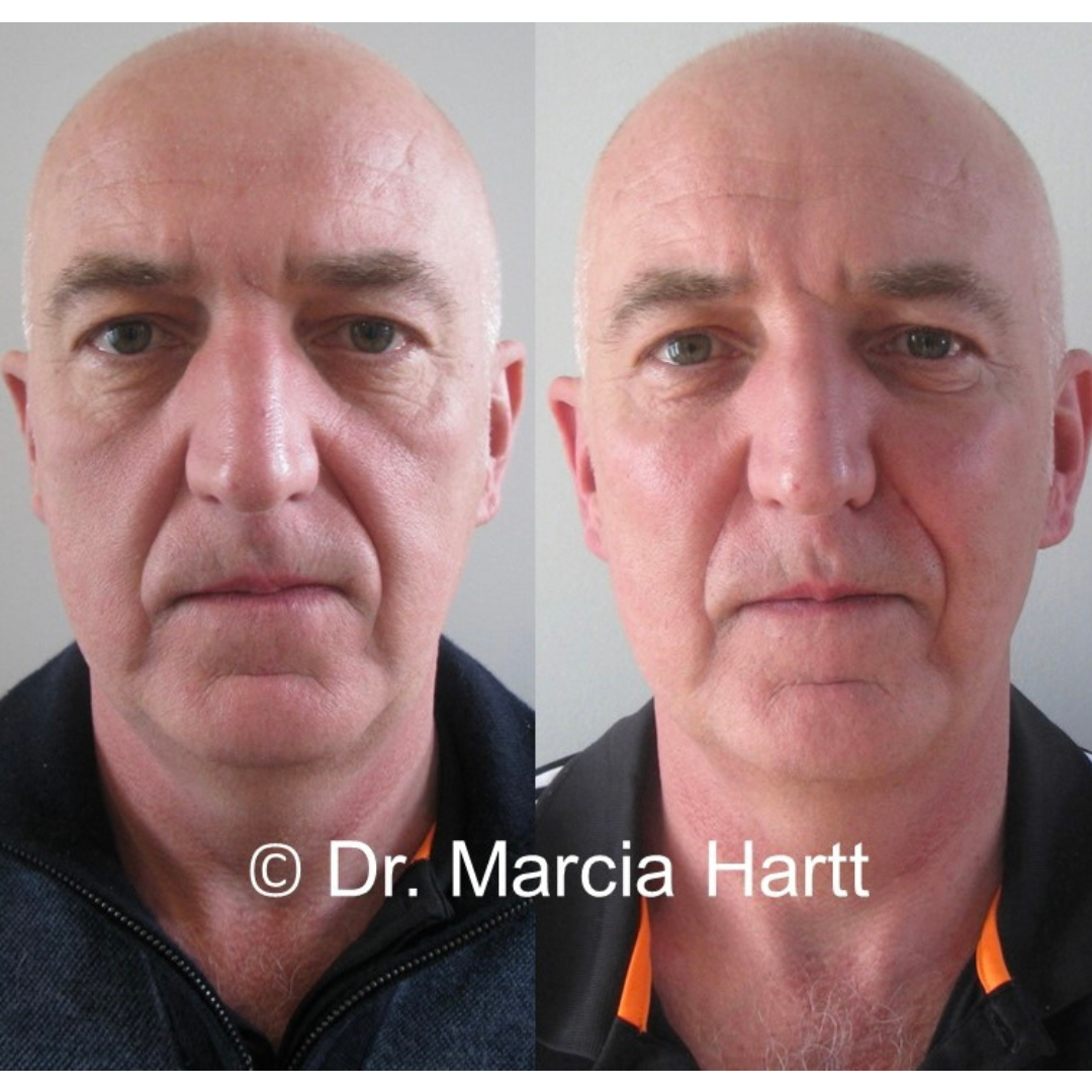 Before and After showing man appearing significantly more well rested after hyaluronic acid filler treatment with Dr. Marcia Hartt