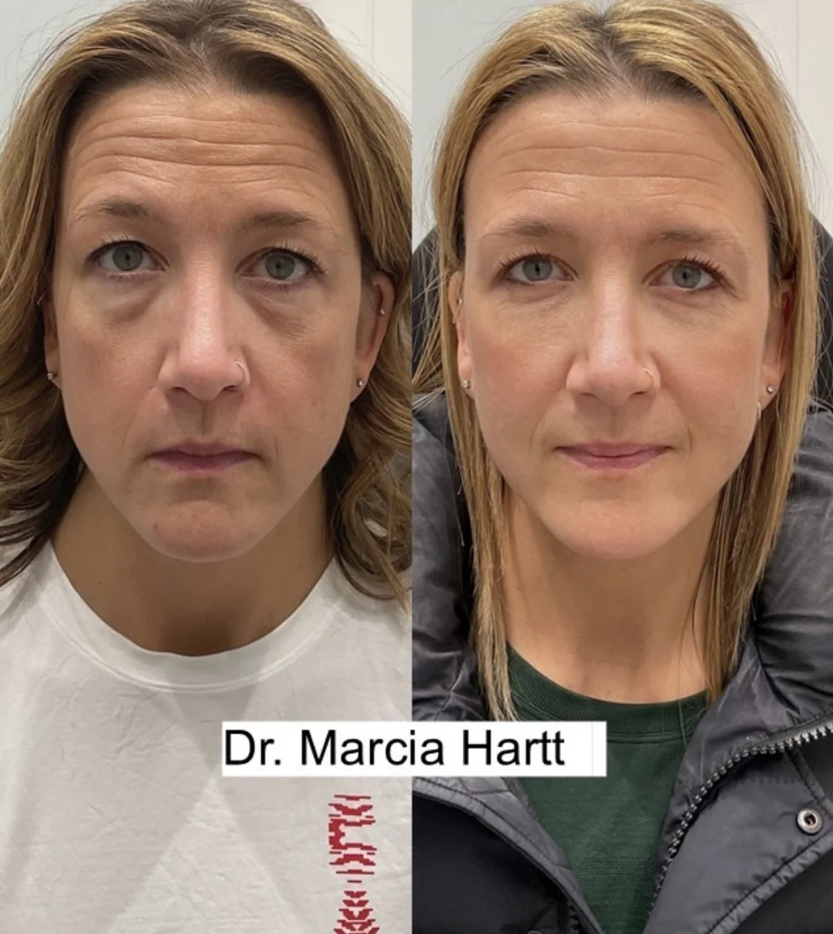 Before and after of facial balancing results from HA dermal filler by Dr. Marcia Hartt at External Affairs in St. Albert