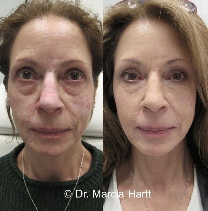 Eye bags significantly reduced before and after using HA dermal fillers by Dr. Marcia Hartt