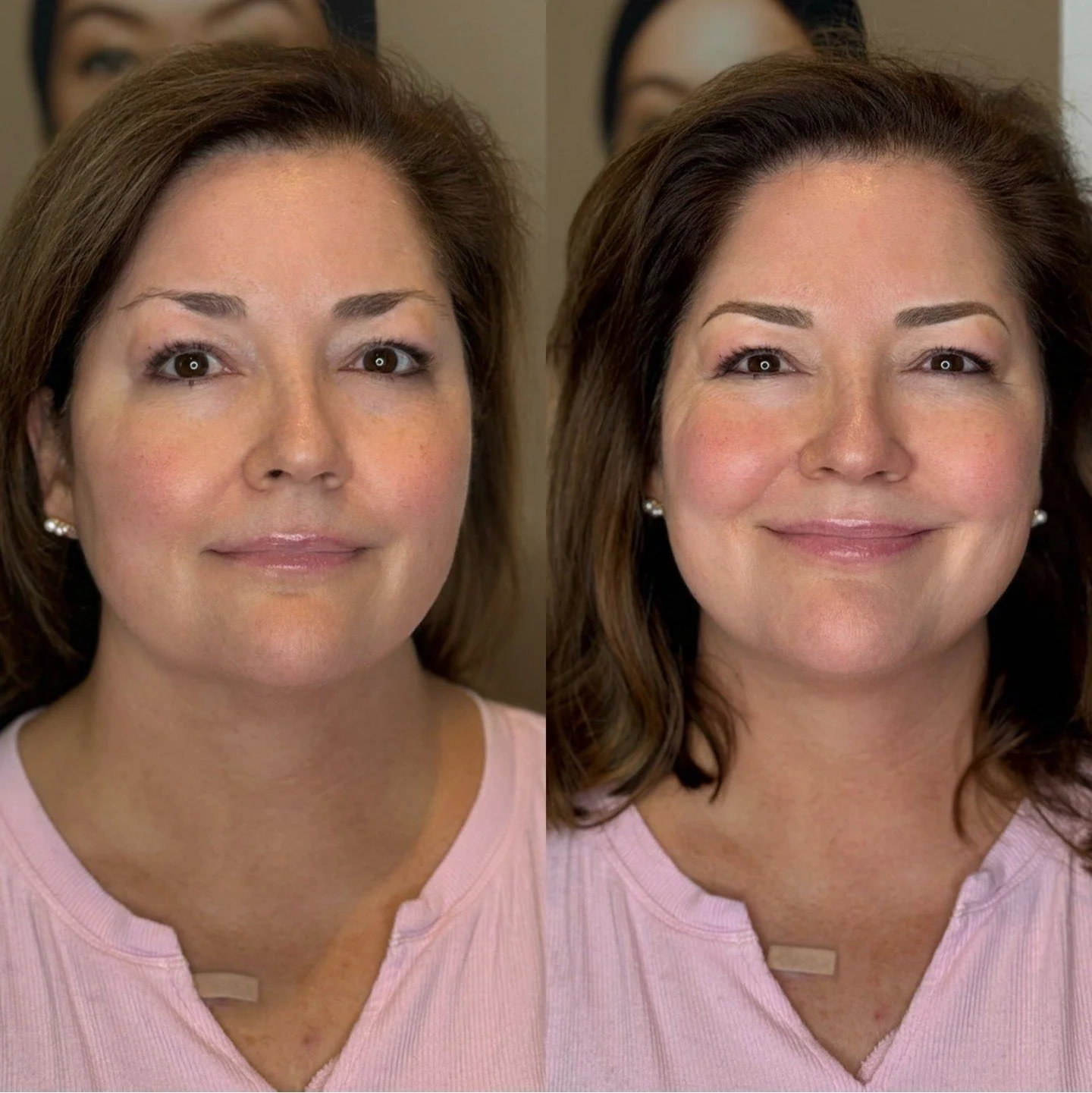 Side-by-side comparison of a middle-aged woman before and after a cosmetic treatment, showing clearer skin and enhanced facial features.