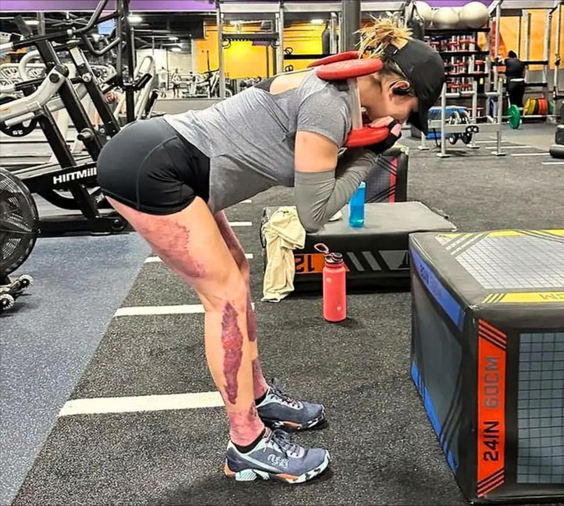 Rachel Huncke is at the gym leaning forward in a weightlifting position. She is wearing workout clothes and headphones, with burn scars visible on her legs.