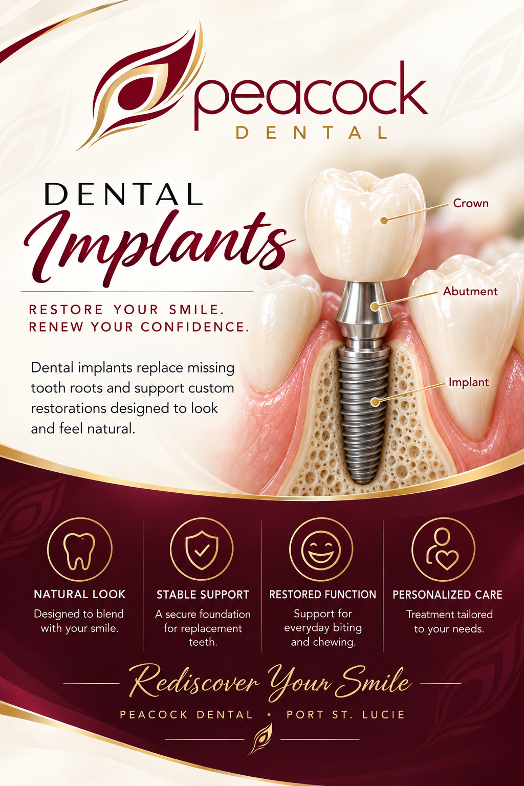 A promotional graphic from Peacock Dental advertising dental implants, showing a cross-section of gums with a dental implant, abutment, and crown labeled, with icons and text highlighting benefits such as natural look, stable support, restored function, and personalized care.