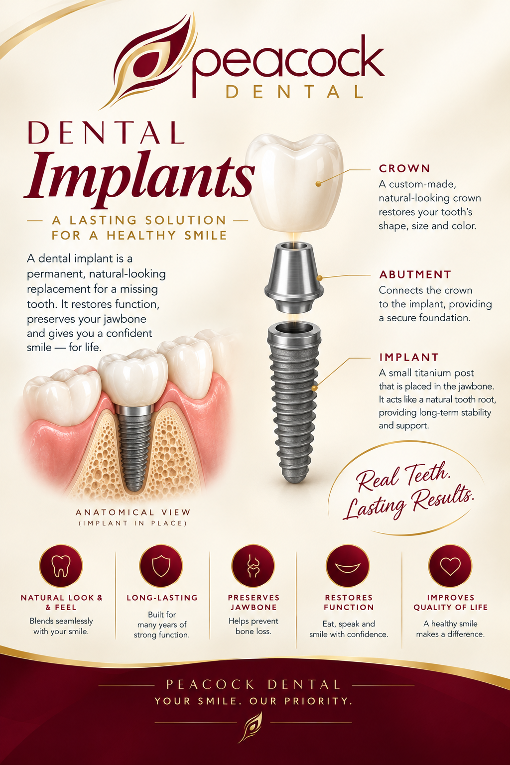 An infographic explaining dental implants from Peacock Dental, including a diagram of a dental implant with labeled parts: crown, abutment, and implant. It highlights the benefits of dental implants such as natural look and feel, long-lasting, preserves jawbone, restores function, and improves quality of life.