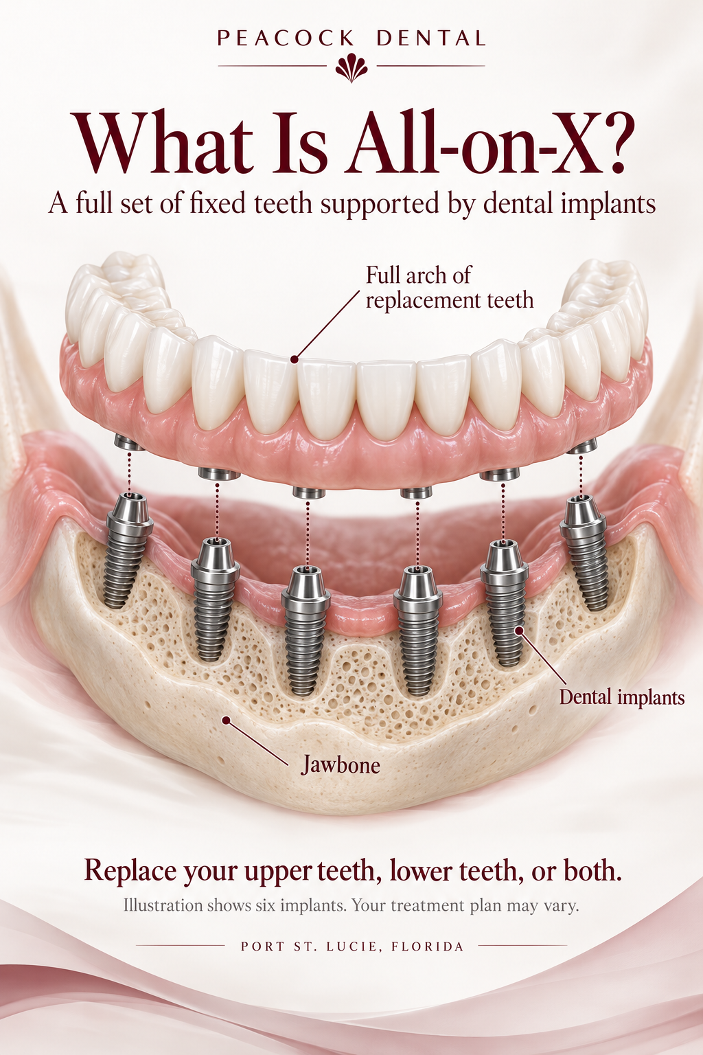 An illustration showing dental implants in the jawbone supporting a full arch of replacement teeth, with labels for full arch of replacement teeth, dental implants, jawbone, and full-on-X full set of fixed teeth supported by dental implants.