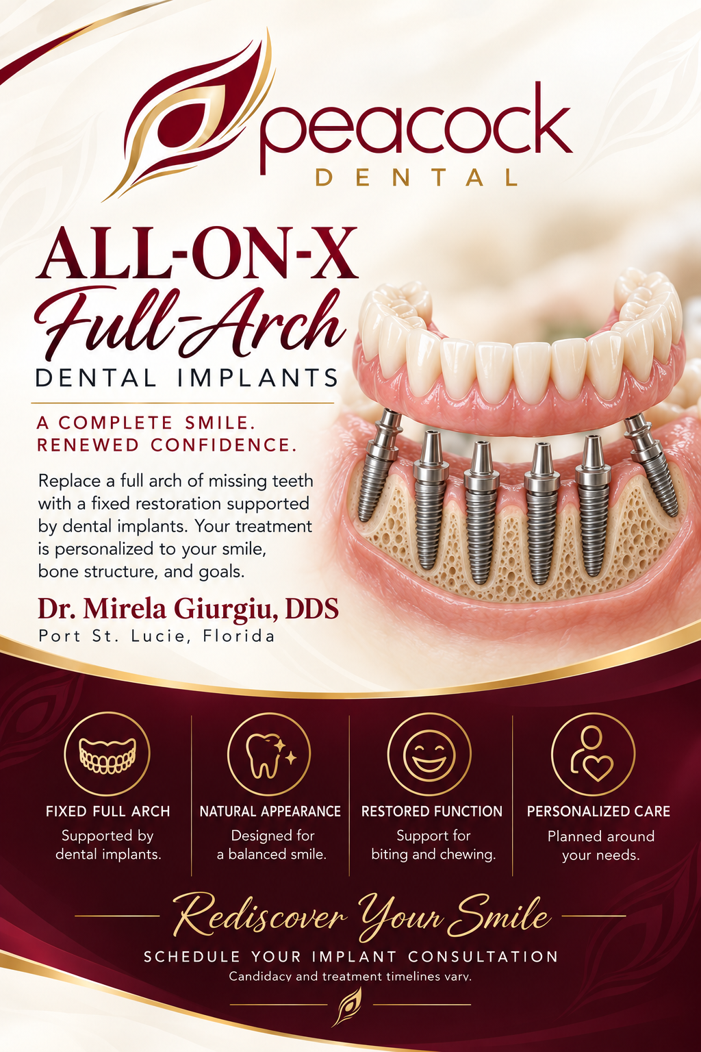 A promotional flyer for Peacock Dental featuring All-On-X Full Arch dental implants with an image of an implant-supported dental prosthesis. The flyer highlights benefits such as a complete smile, restored confidence, natural appearance, supported function for biting and chewing, and personalized care. It includes contact information for Dr. Mirela Giurgiu in Port St. Lucie, Florida, and encourages scheduling an implant consultation.