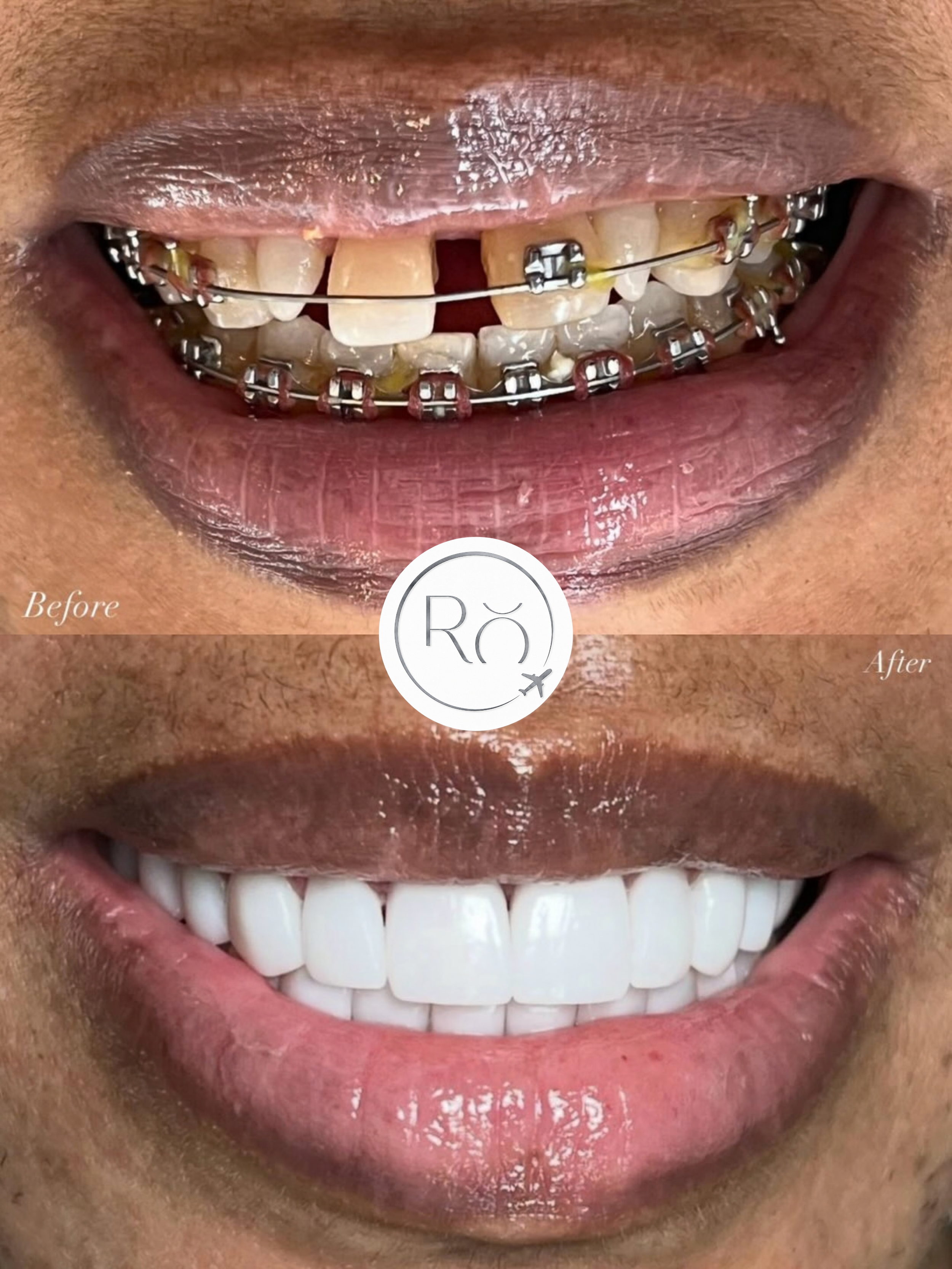 Porcelain Veneers — Smile Design