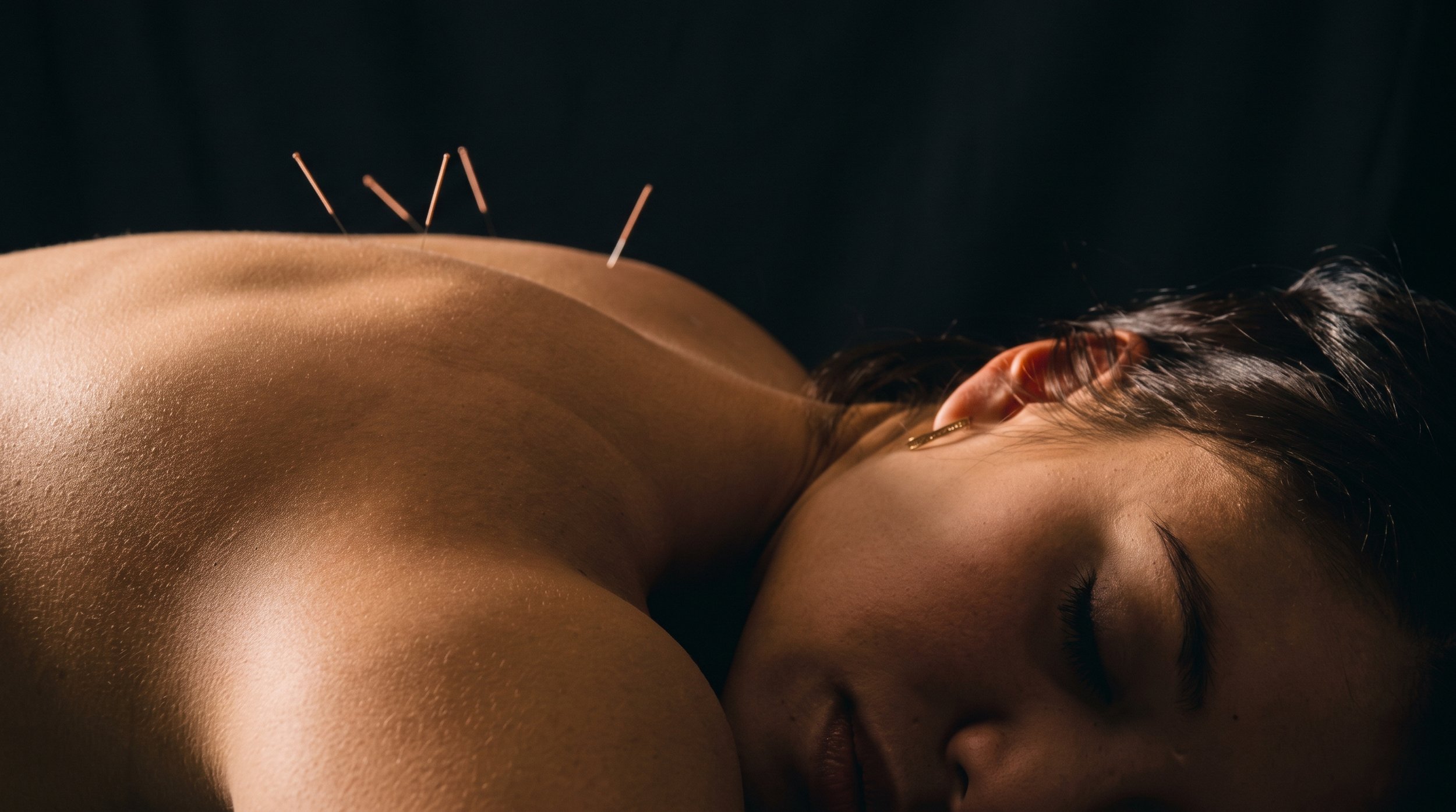 Close-up of a person receiving acupuncture needles in their upper back during a treatment.