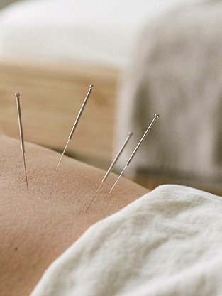 Acupuncture needles inserted into a person's back.