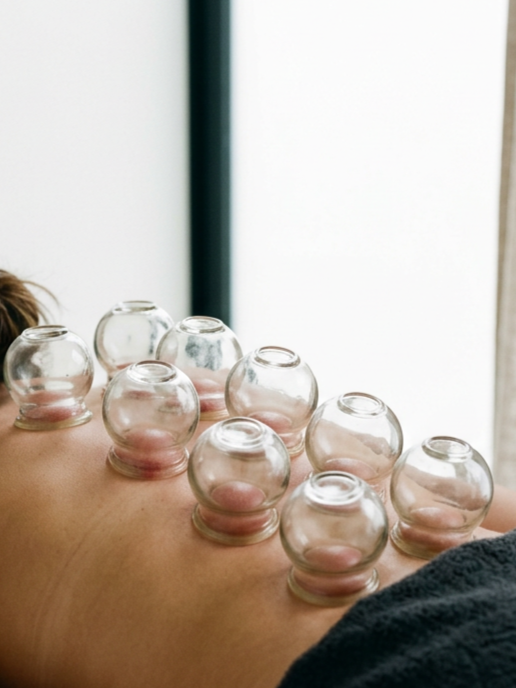 Person receiving cupping therapy with multiple glass cups placed on their back