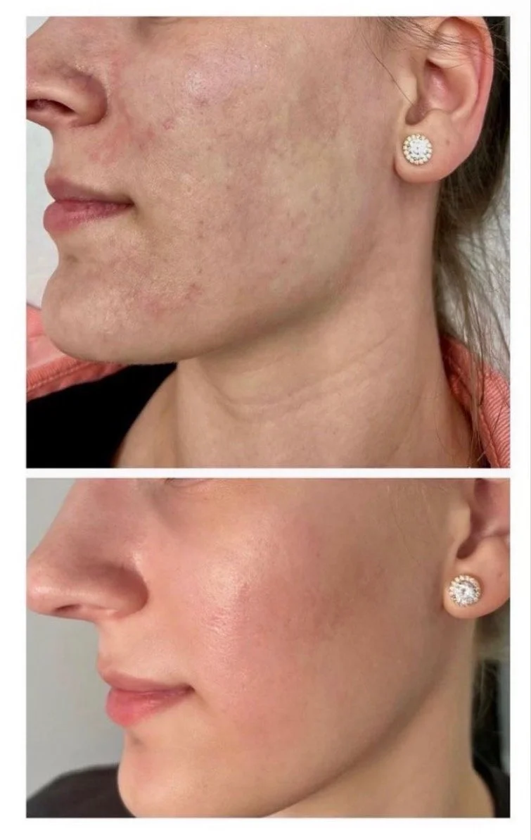 Side-by-side comparison of a woman's face showing skin improvement; top image depicts skin with redness, acne scars, and uneven texture, while the bottom image shows clear, smooth, and glowing skin.