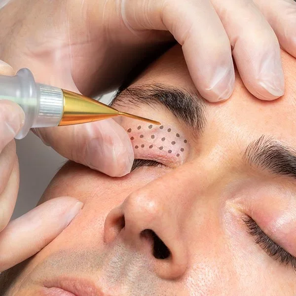 A person receiving an eye area injection with a syringe, with a dotted grid marked on the skin for precise injection placement.