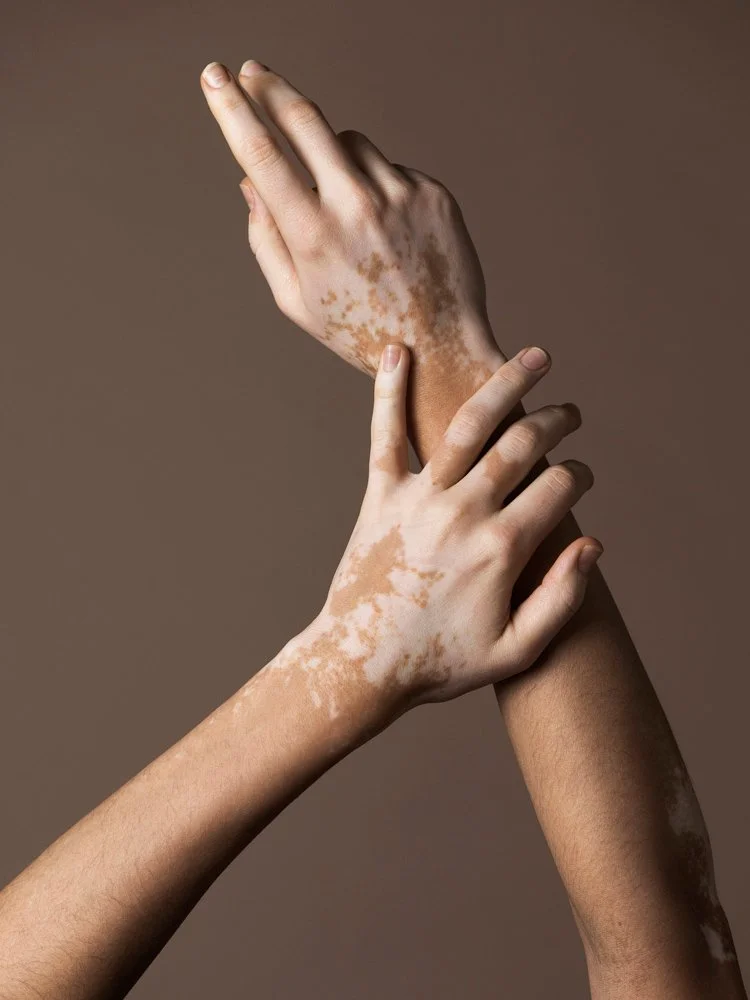 Nahaufnahme mehrerer Hände mit sichtbaren Vitiligo-Flecken vor braunem Hintergrund