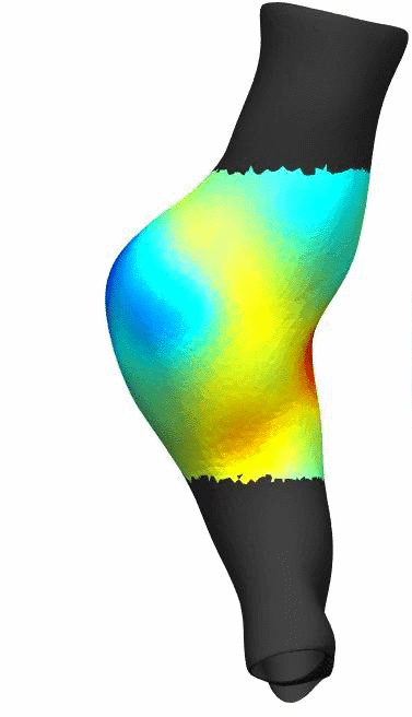 Rotating computational model of an aortic aneurysm.