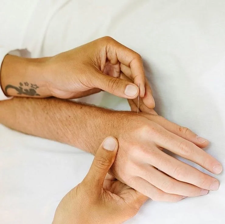 Acupuncturist inserting a fine needle into a person’s forearm and wrist area.
