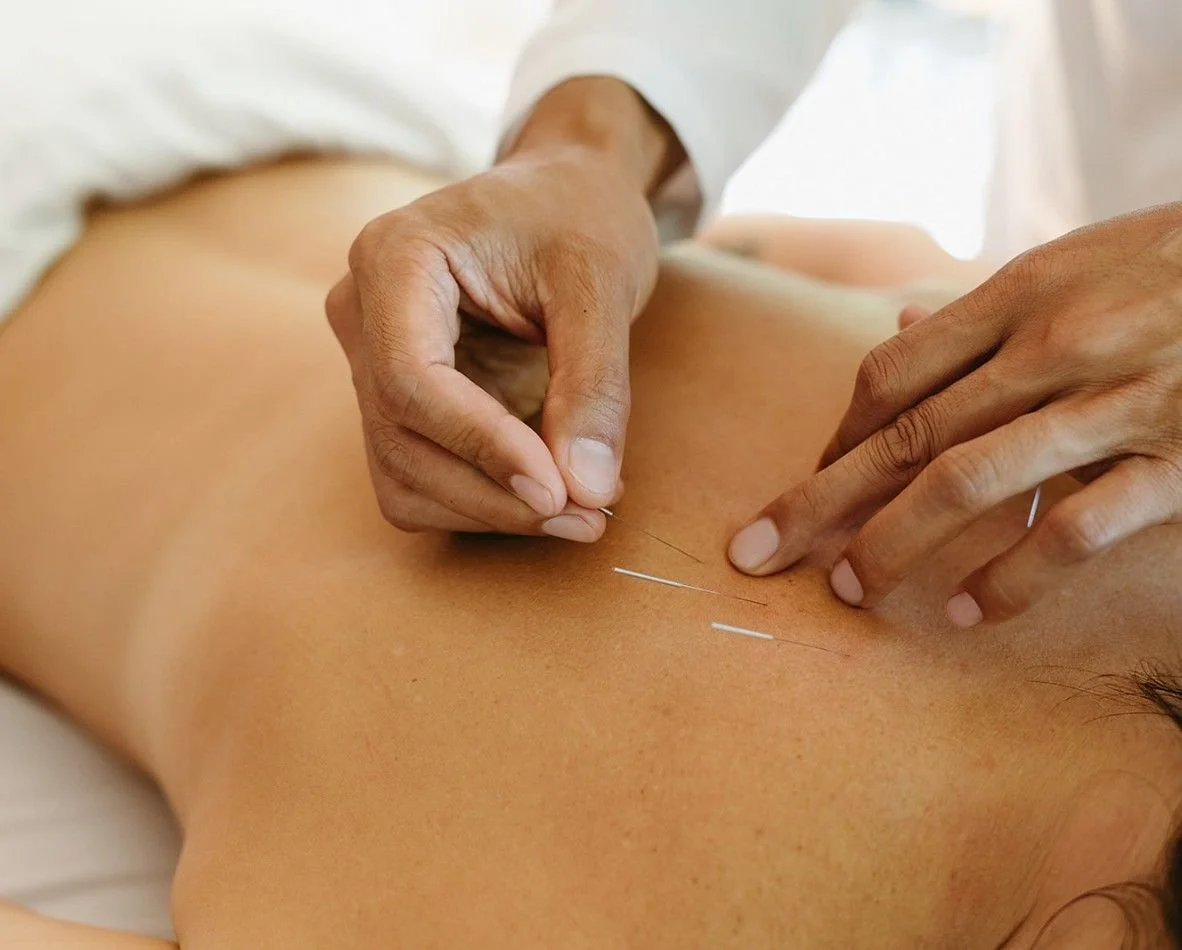 Acupuncturist inserting needles into a patient's back during acupuncture treatment