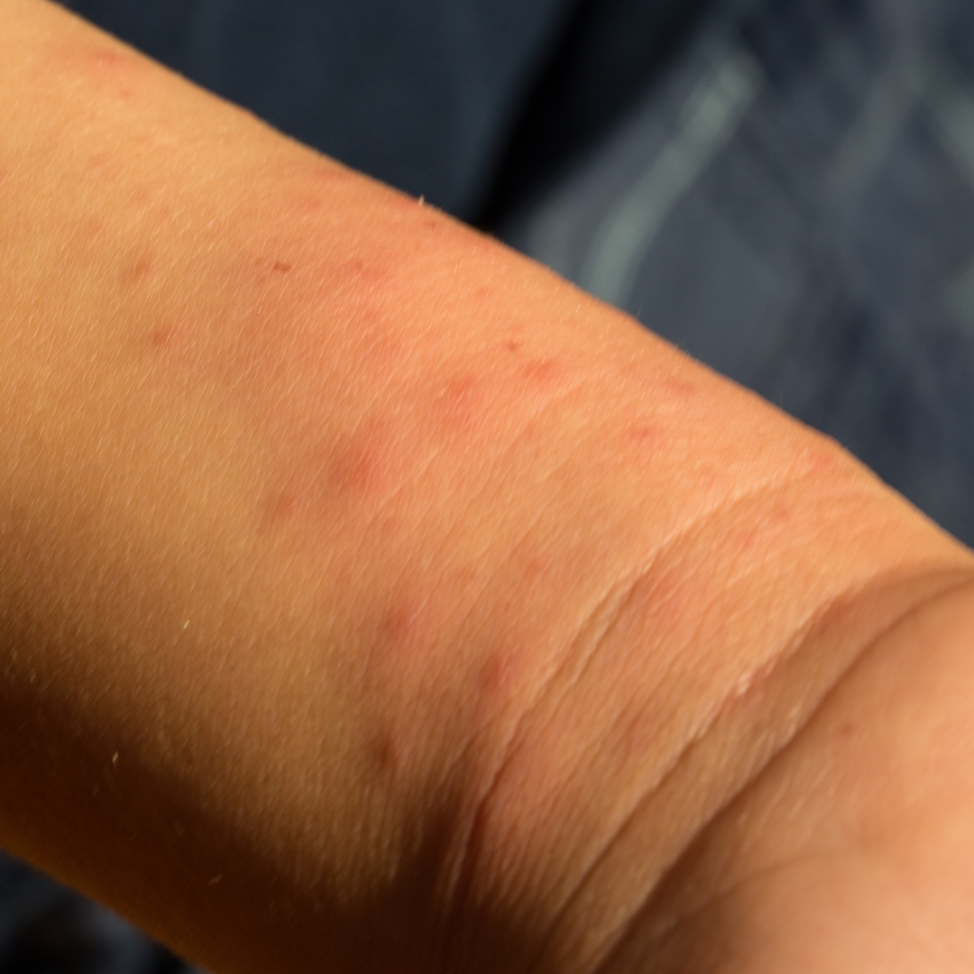 Are Bed Bug Bites Dangerous? Health Risks to Consider