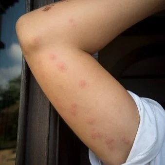 The Difference Between Bed Bug Bites and Flea Bites