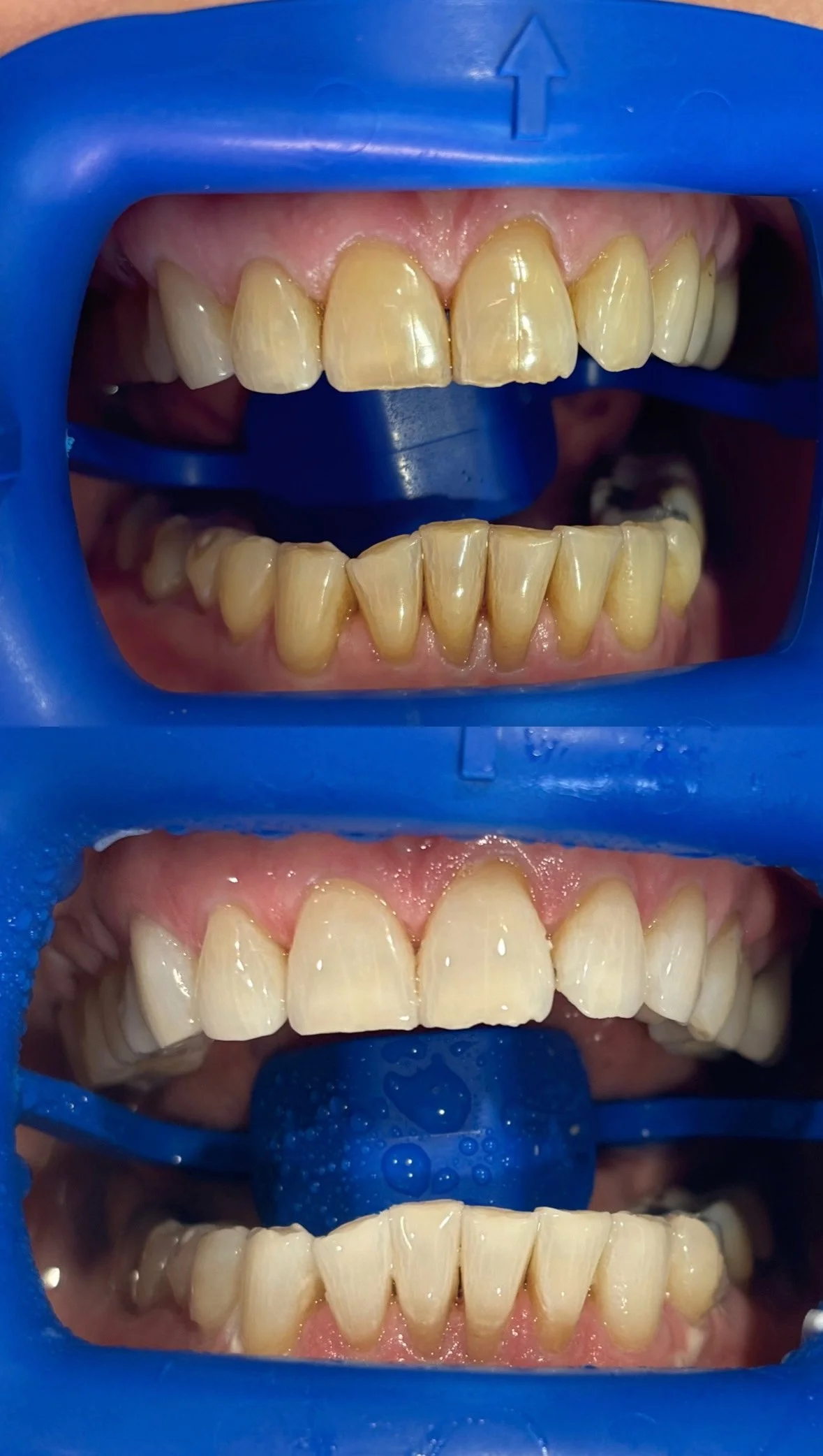 This patient underwent a 1.5 hour Zoom In-Chair Whitening session. The goal of the treatment was to improve overall appearance and reduce the discolouration exacerbated by tobacco smoking and coffee. These photos were taken immediately before and aft