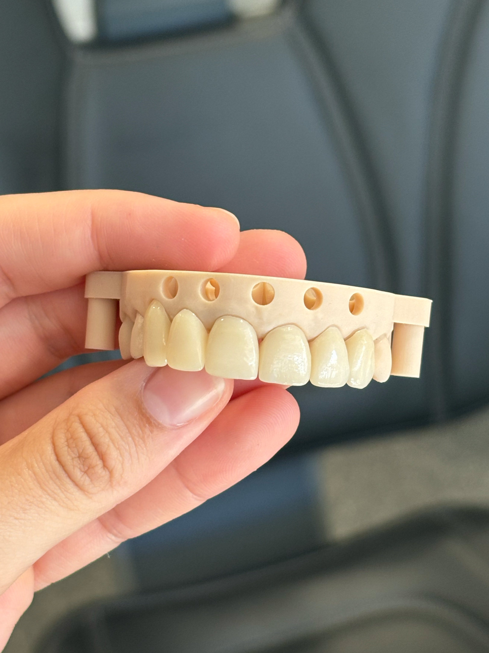 6 emax veneers in shade A3 on a 3D printed model immediately before being cemented. Fabricated by an external laboratory.