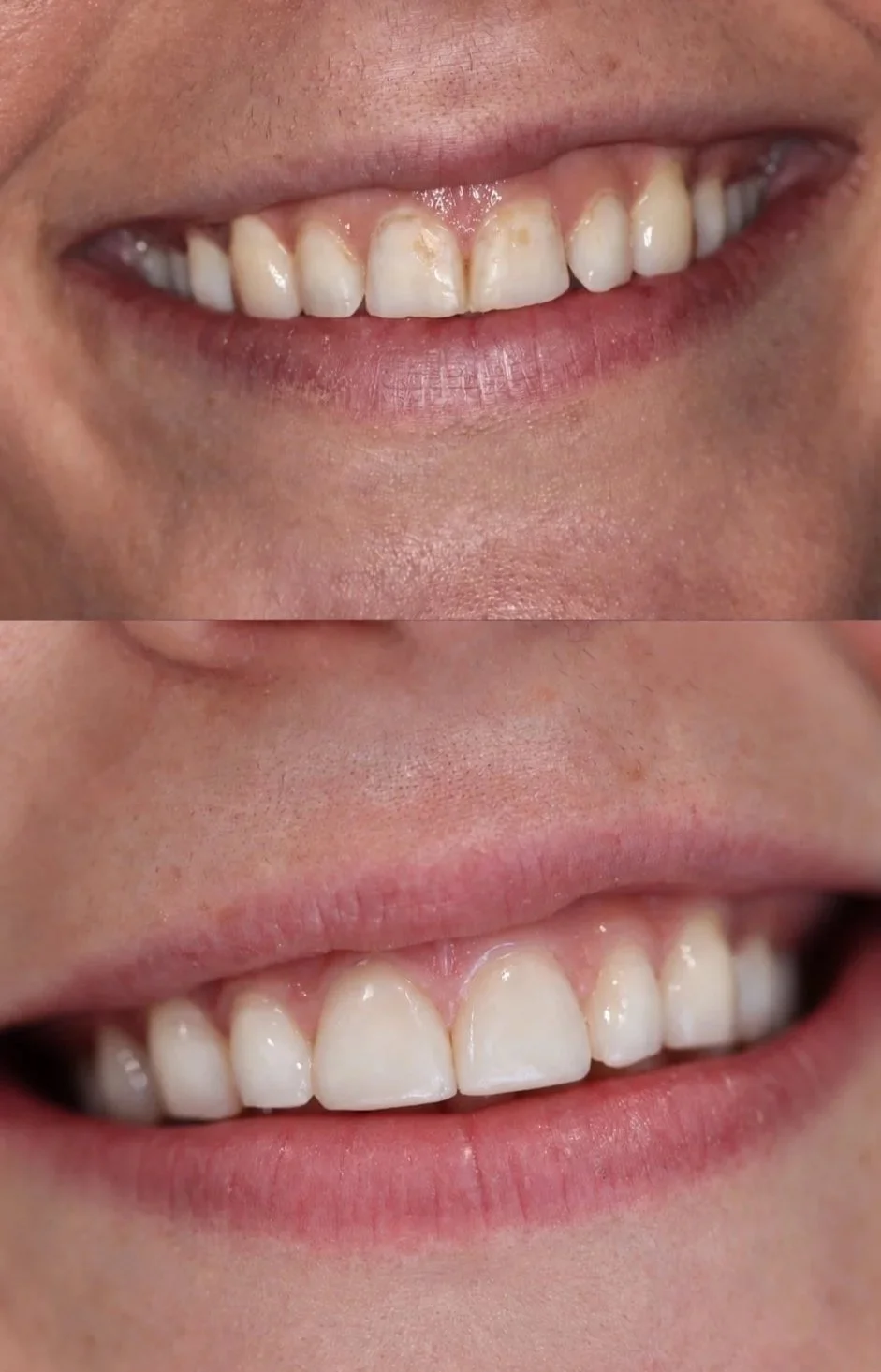 This patient underwent stain removal, emax veneers on both central incisors, and composite bonding on both lateral incisors. The goal of the treatment was to improve the size, shape and discolouration of the front 4 teeth. The treatment took 6 weeks 