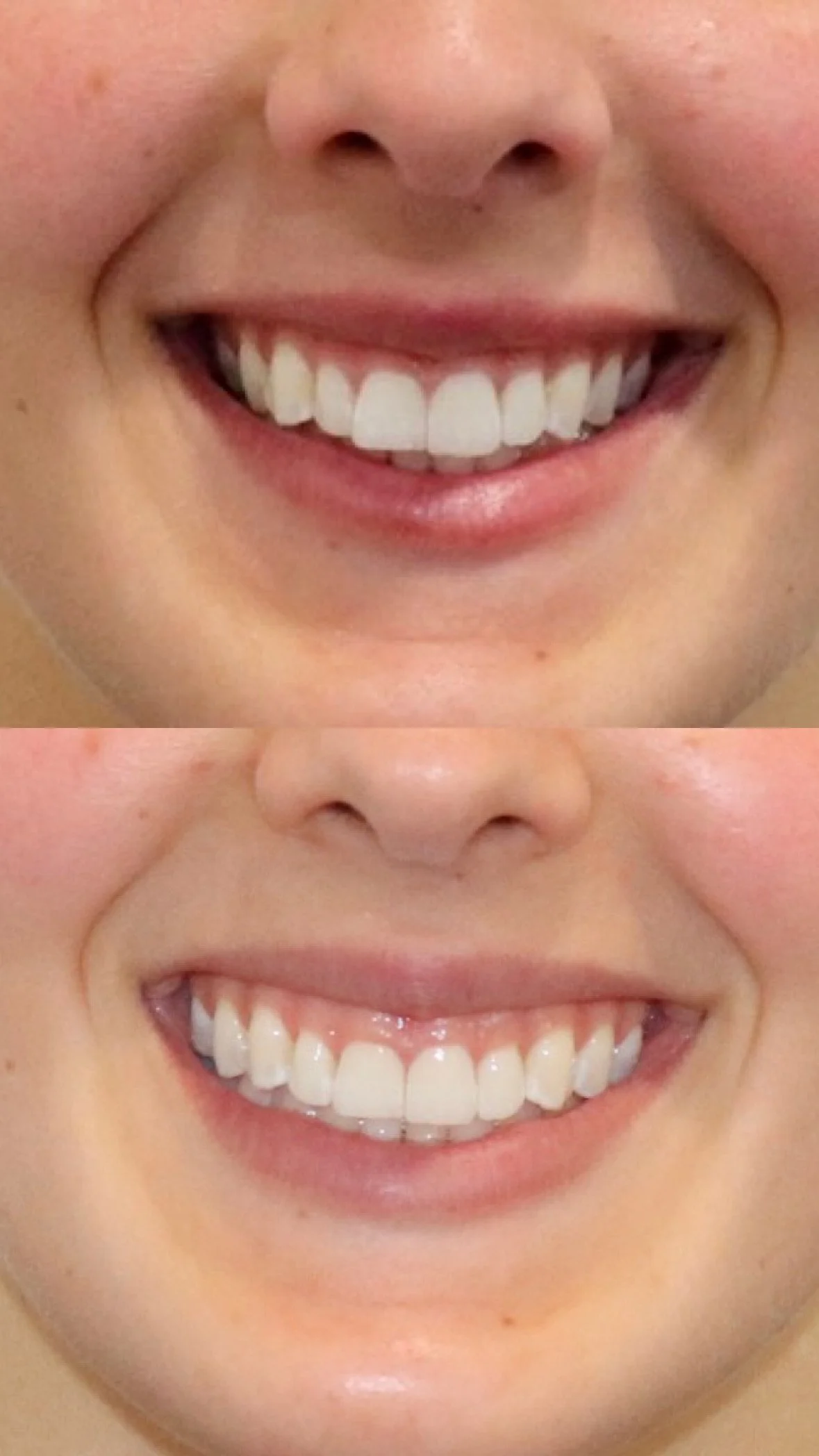 This patient underwent 20 weeks of clear aligner treatment. The goal of the treatment was to widen the smile and fill the dark corners (buccal corridor). Photos were taken immediately before and after treatment.