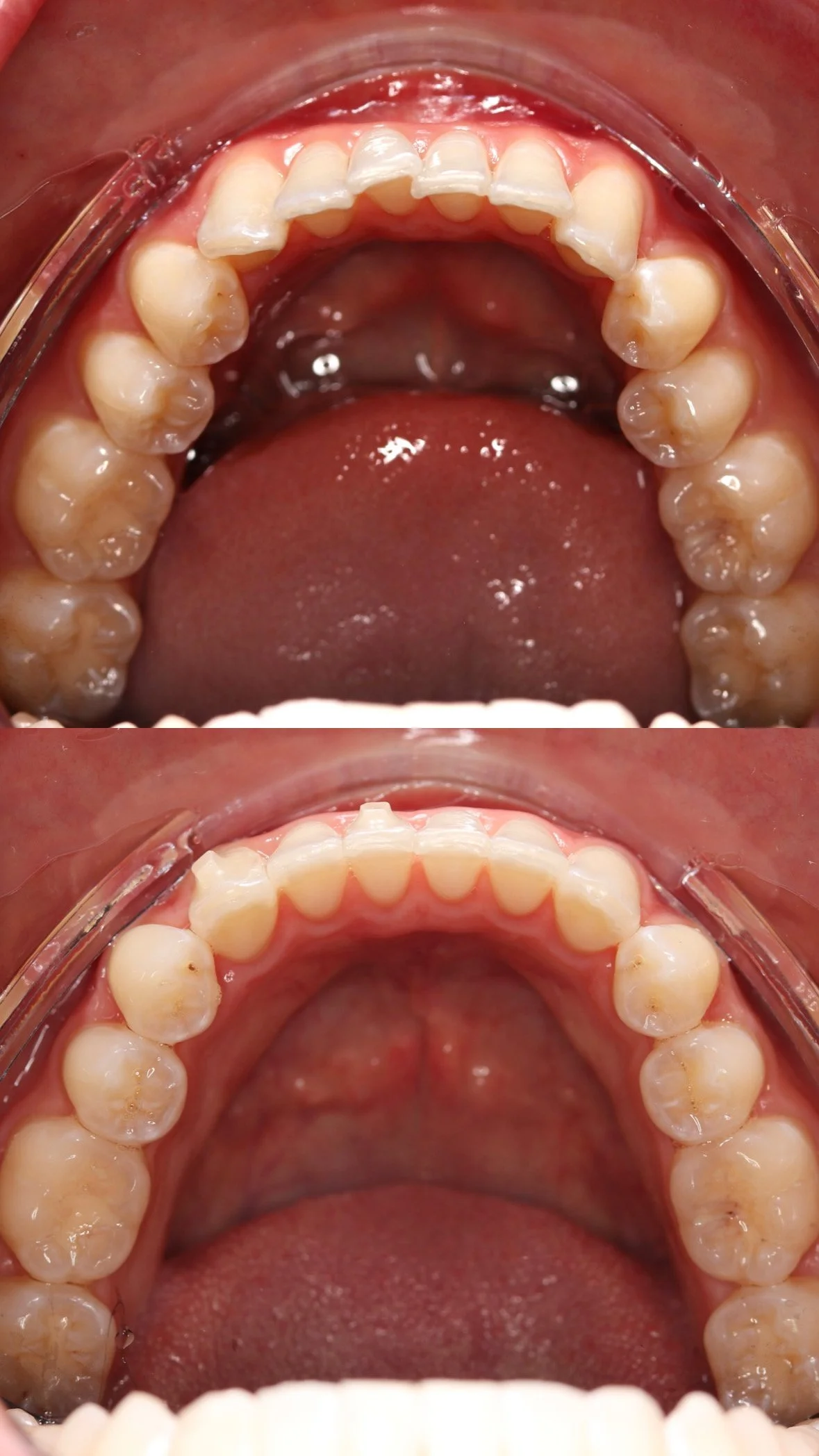 This patient underwent 20 weeks of clear aligner treatment. The goal of the treatment was to improve the alignment of the crowded lower front teeth. Photos were taken immediately before and after treatment. 