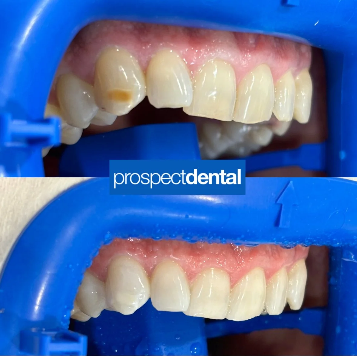 This patient underwent a 1.5 hour Zoom In-Chair Whitening session. The goal of the treatment was to improve overall appearance and reduce the discolouration on the right canine. These photos were taken immediately before and after treatment.