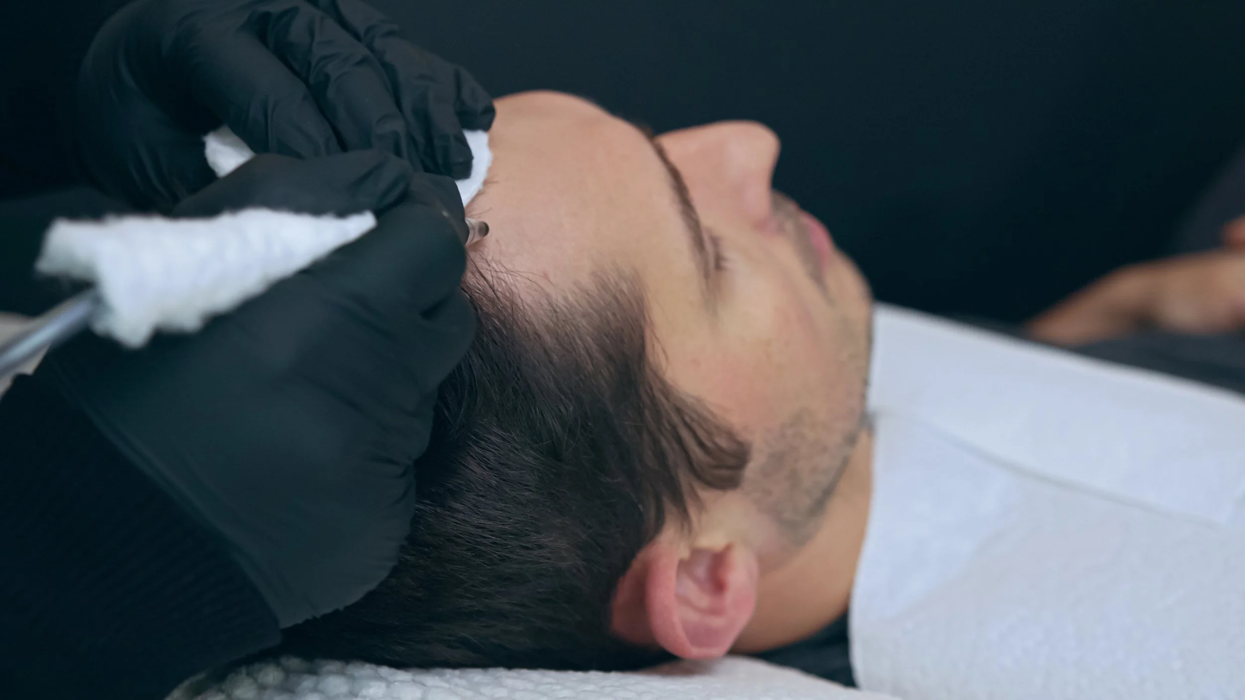 SCALP MICROPIGMENTATION