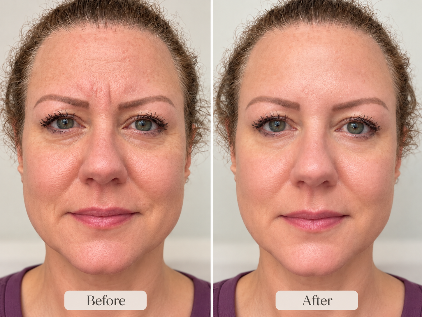 Side-by-side comparison of a woman before and after a cosmetic procedure showing smoother skin and fewer wrinkles.