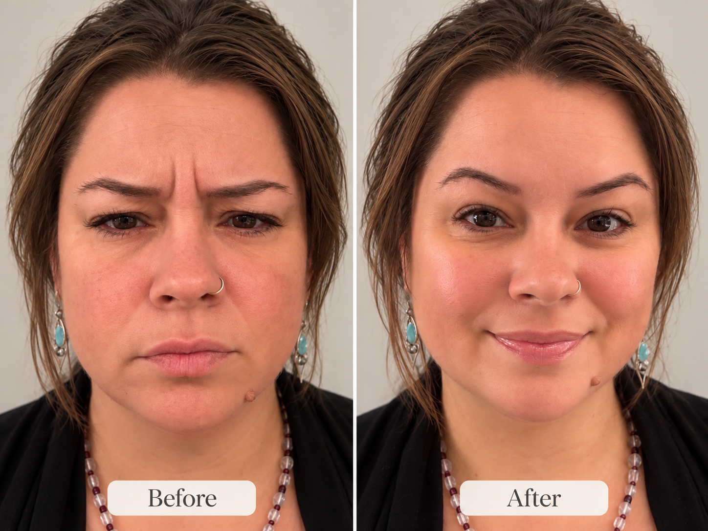 Comparison of a woman before and after a cosmetic treatment. The left side shows her frowning with visible wrinkles, while the right side shows her smiling with smoother, clearer skin.