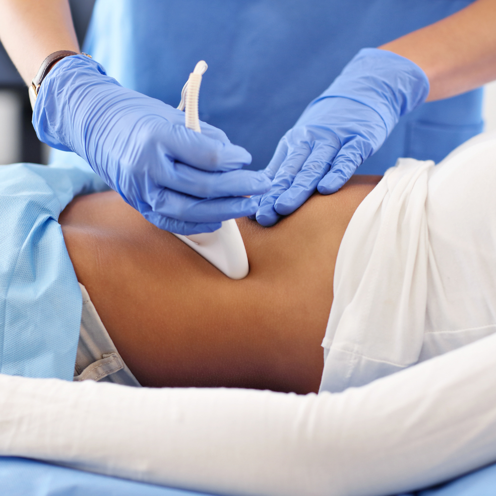 A medical professional wearing blue gloves draws fluid from a patient's abdomen during a medical procedure.