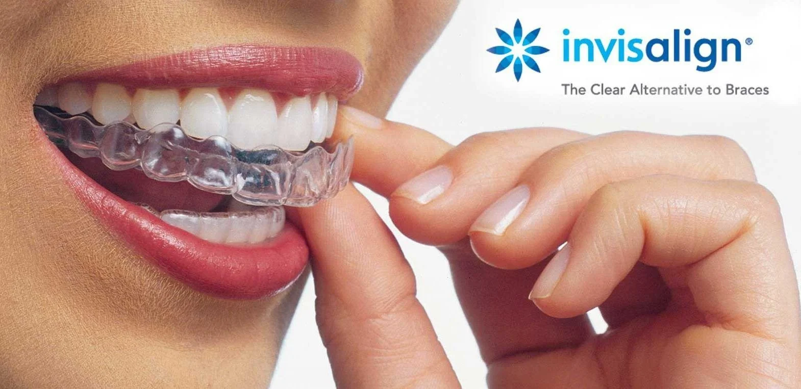 Close-up of a woman holding a clear Invisalign aligner near her teeth, with the Invisalign logo and text indicating it is a clear alternative to braces.