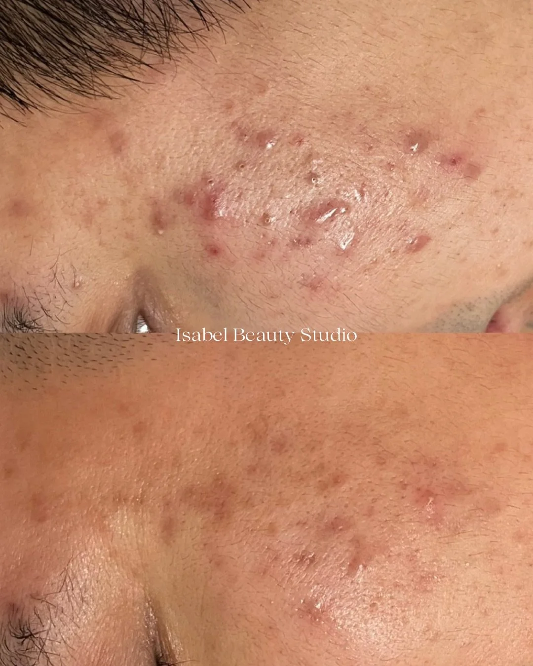Before-and-after close-up of facial skin showing acne and reduced redness and blemishes after treatment