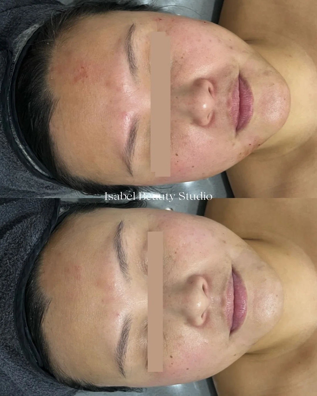 Before-and-after facial skincare treatment photos showing a woman’s complexion and eyebrows, with visible skin redness and blemishes.