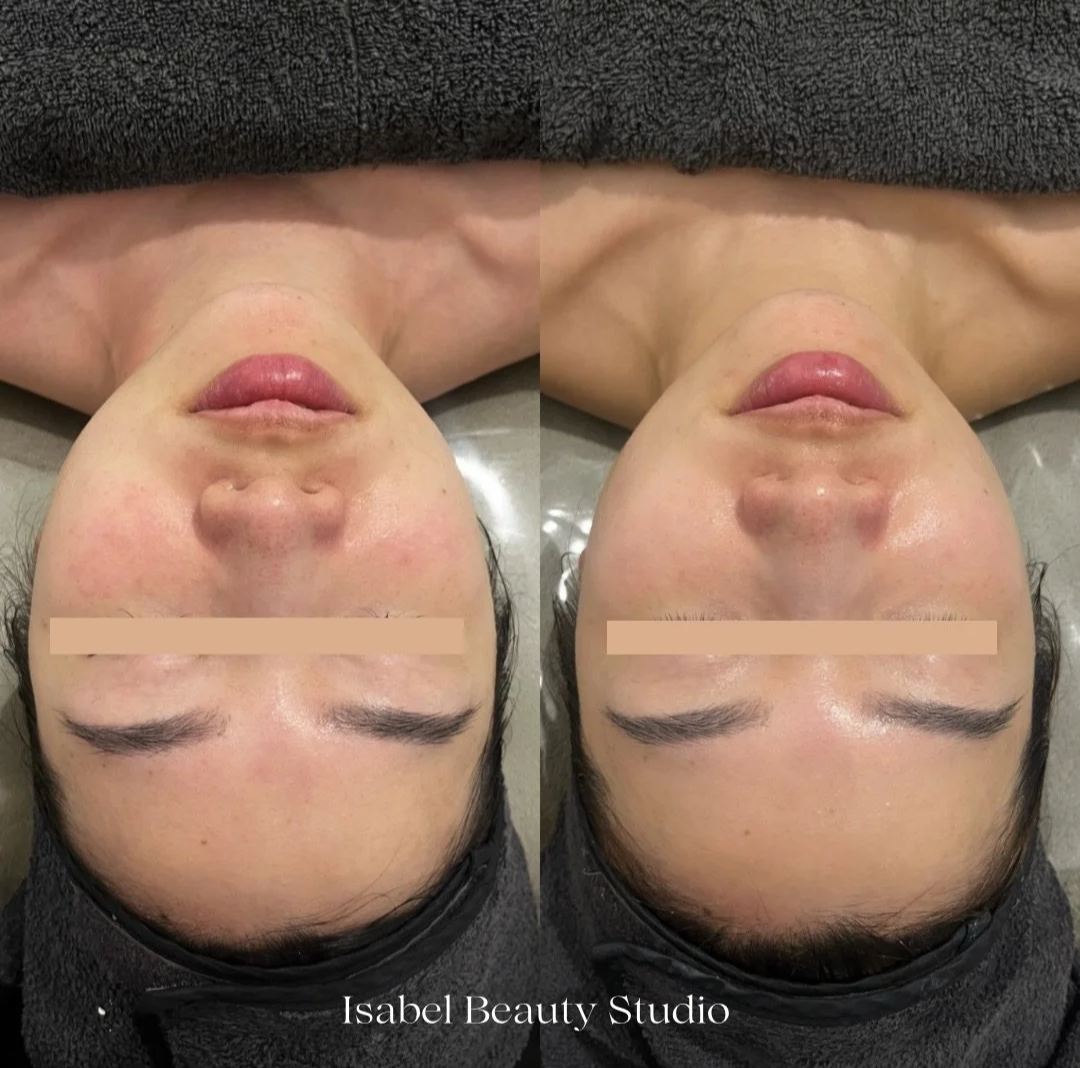 Side-by-side upside-down before-and-after photo of a woman’s face showing cosmetic facial treatment results, with Isabel Beauty Studio watermark