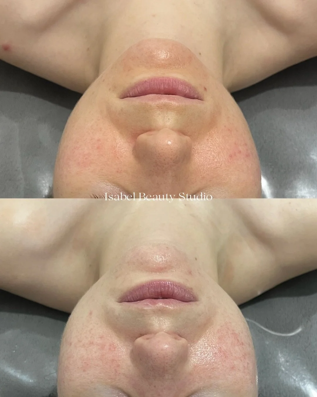 Before-and-after close-up of a client’s facial skin showing reduced redness and blemishes after an Isabel Beauty Studio treatment