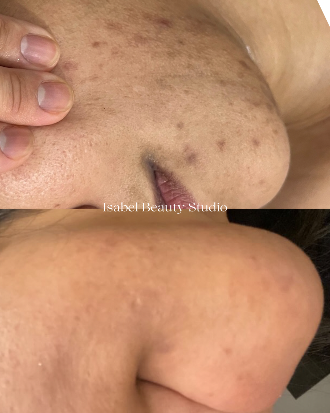 Before-and-after close-up of facial skin showing dark spots and uneven pigmentation, with smoother, more even-toned skin after treatment.