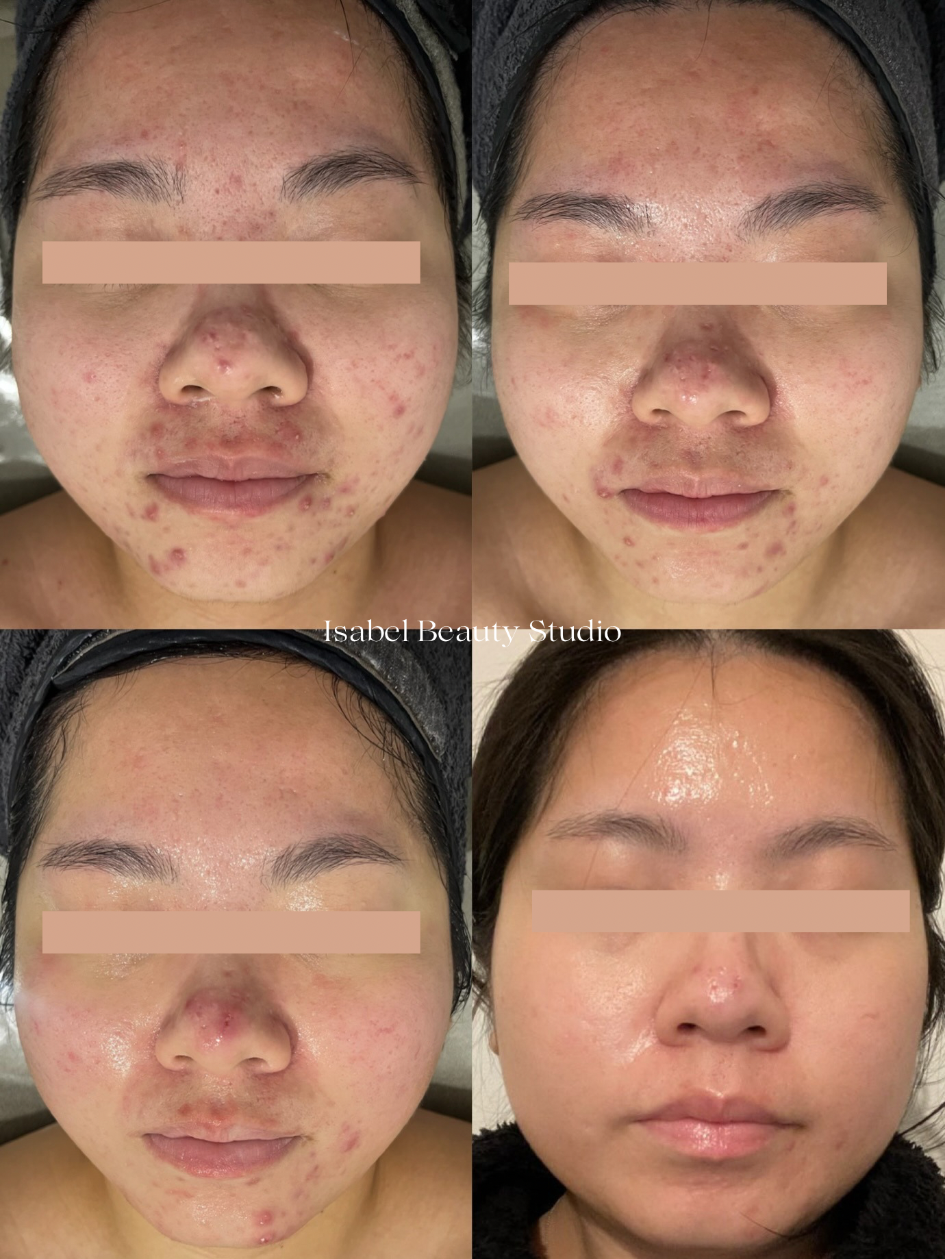 Four-panel facial skincare progress collage showing reduced acne, redness, and blemishes before and after treatment.