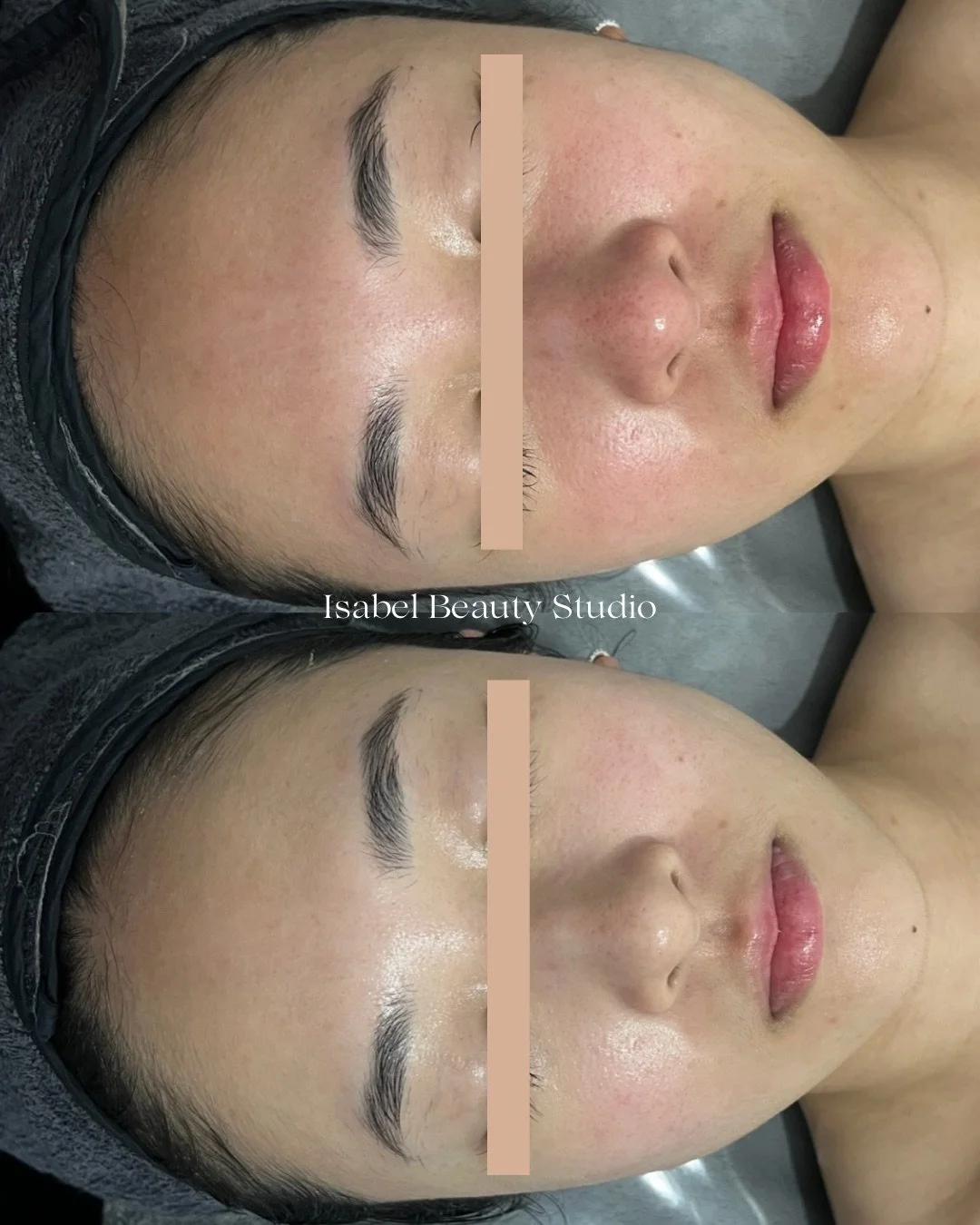 Before-and-after facial skincare treatment showing a woman’s smoother, brighter skin and reduced blemishes.