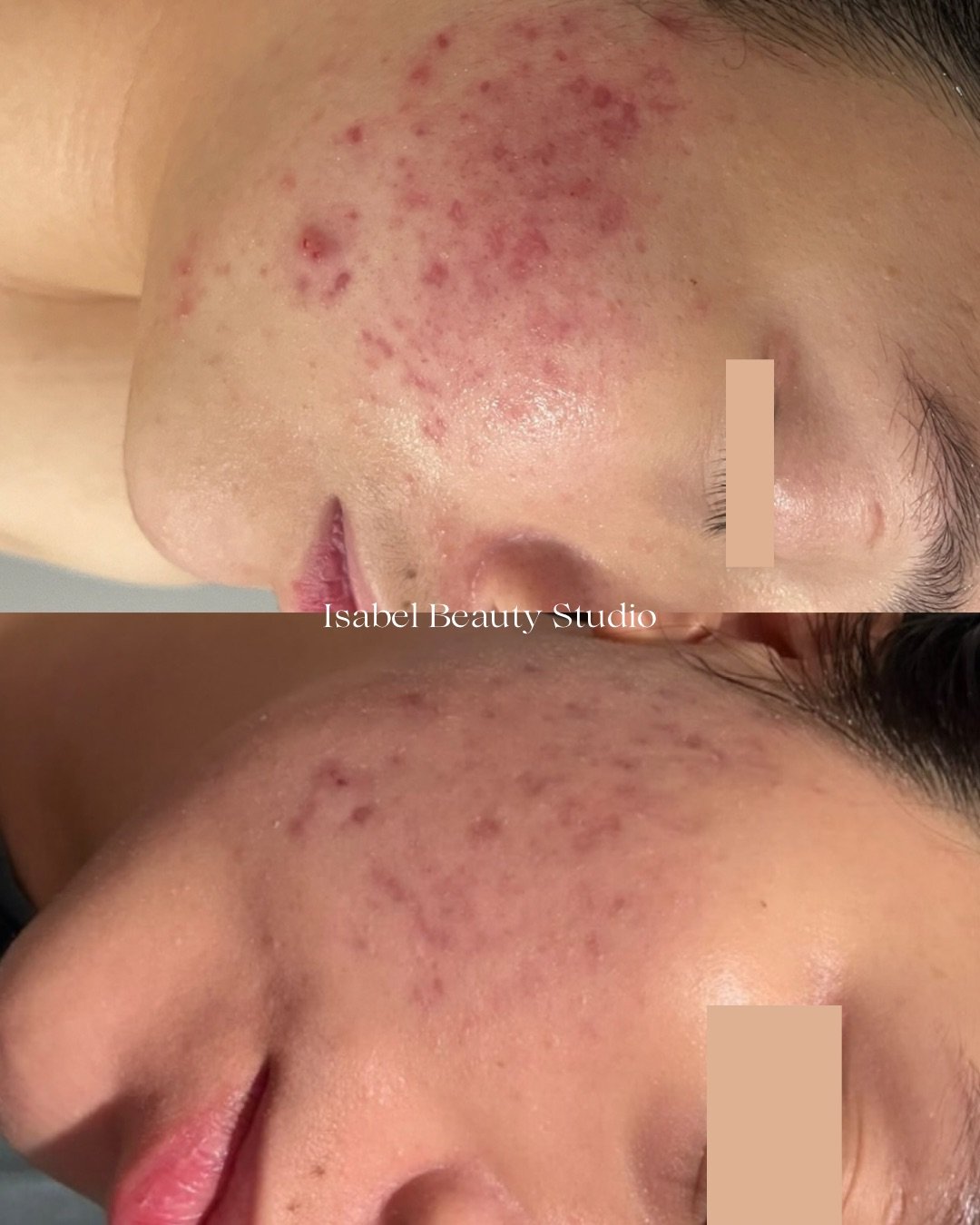Before-and-after close-up photos showing reduced cheek acne, redness, and blemishes after a beauty treatment.