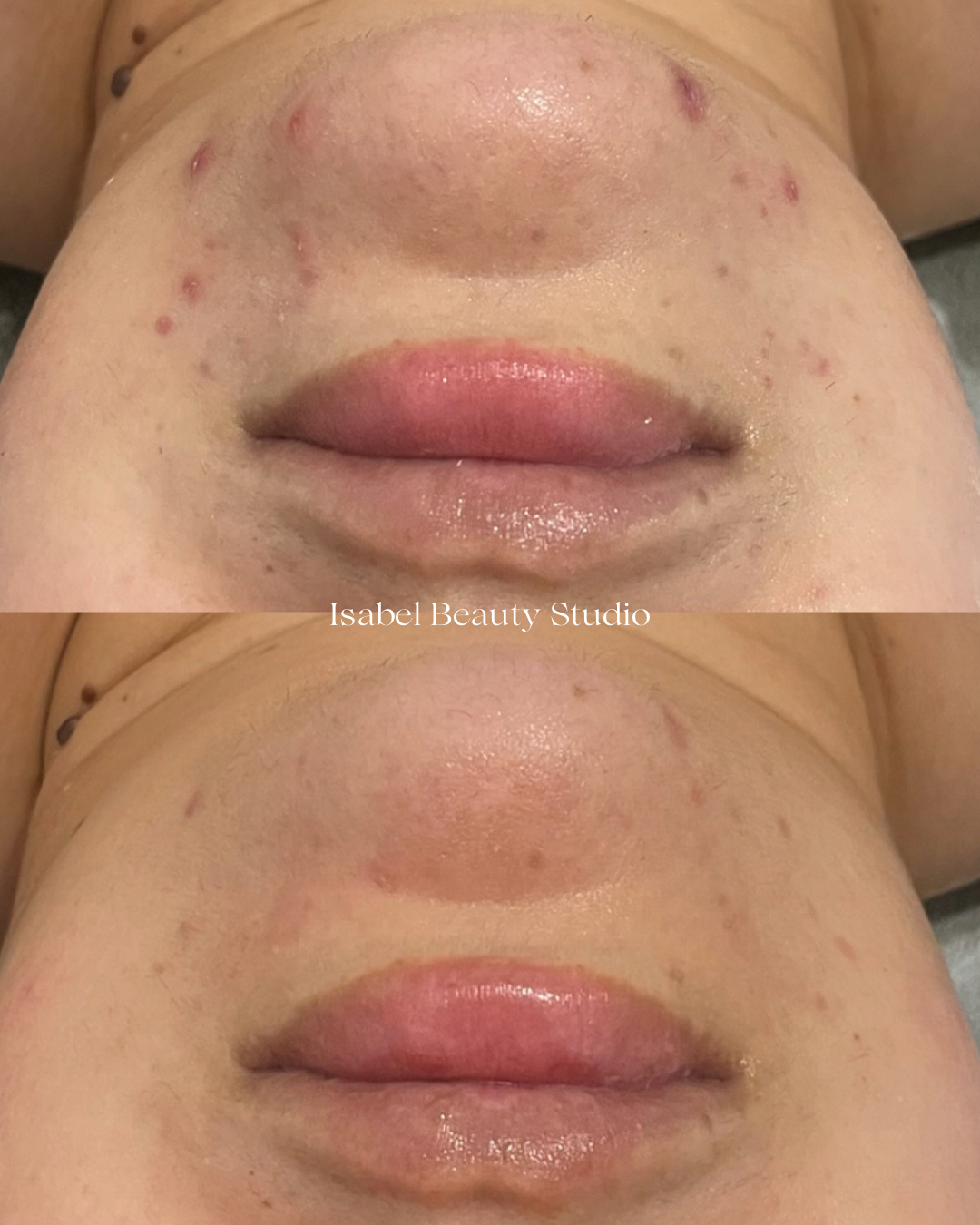 Before-and-after close-up of lips and surrounding skin showing a beauty treatment, with reduced blemishes and redness in the lower image